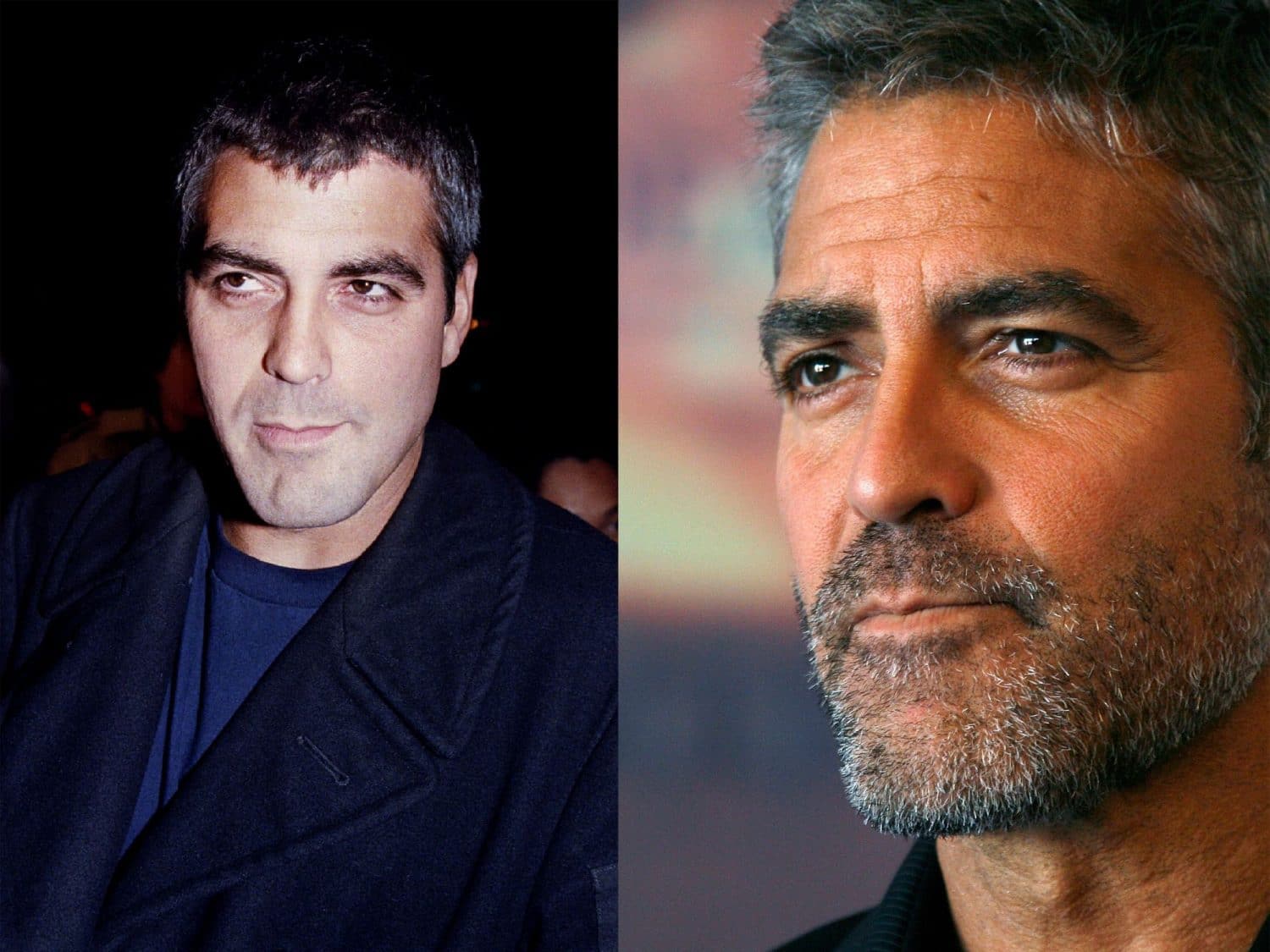 Rhinoplastie deGeorges Clooney