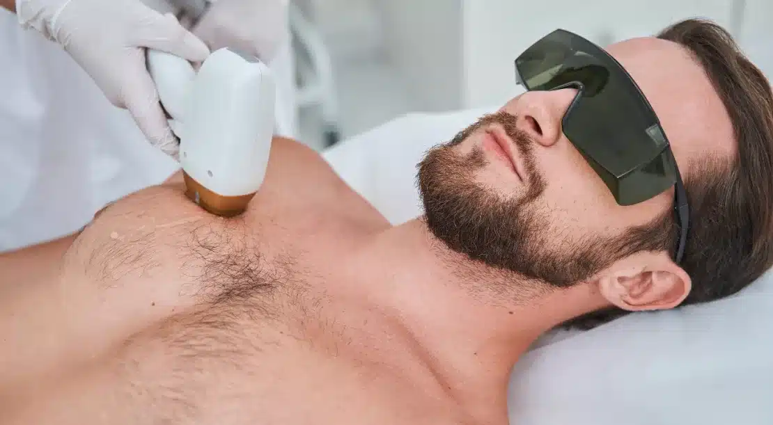 L’épilation laser au masculin
