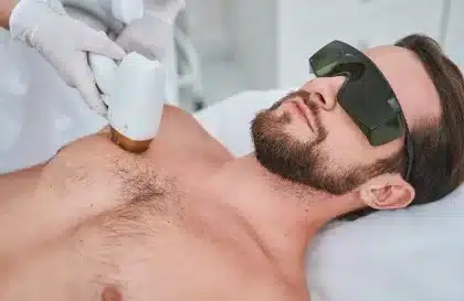 L’épilation laser au masculin