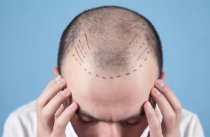 Greffe de cheveux et estime de soi : une nouvelle confiance en vous