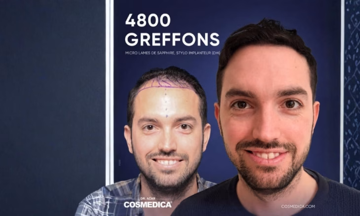 Greffe de cheveux avant/après