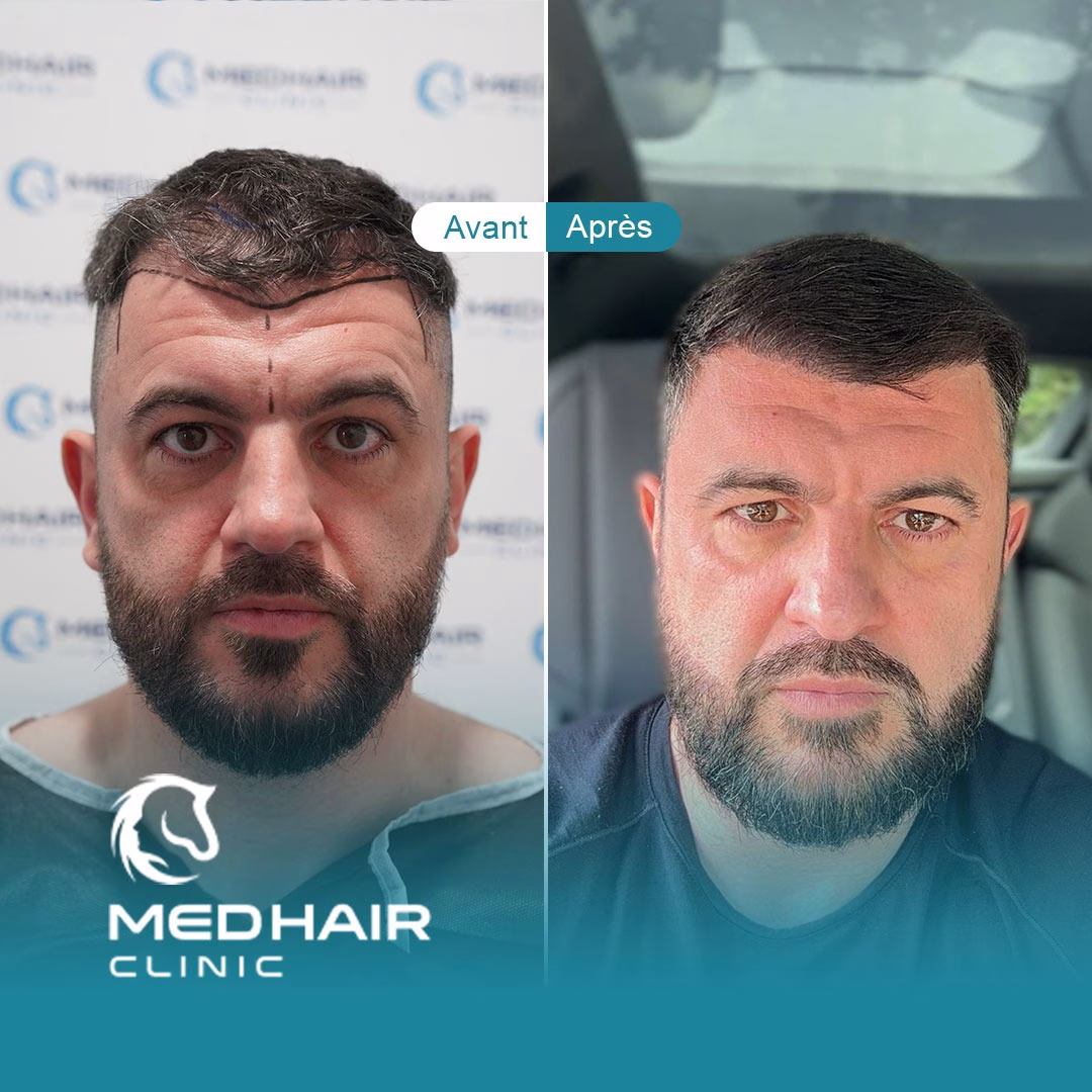 Top 10 des meilleures cliniques de greffe de cheveux en Turquie