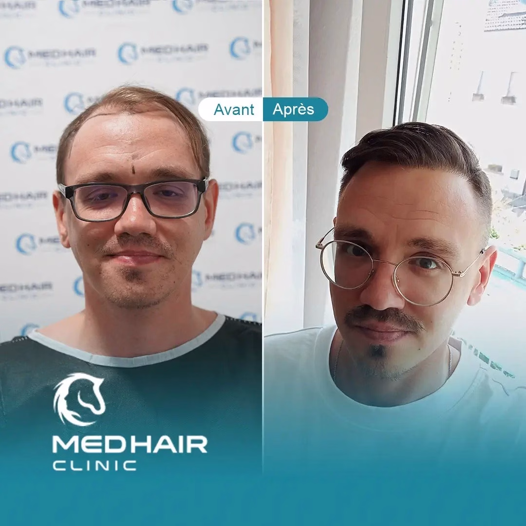 Avant après cliniques de greffe de cheveux en Turquie